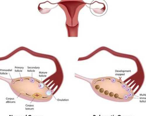 黄体功能异常患者的试管备孕方案