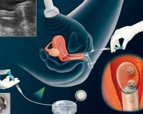 关于试管婴儿费用的常见问题解答